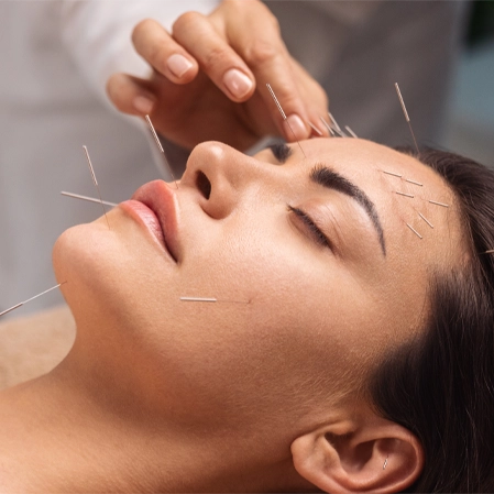 Chiropractic Salisbury NC Woman Receiving Acupuncture